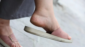 Slippers dangling, cracked heels, foot fetish admiratrion.webp